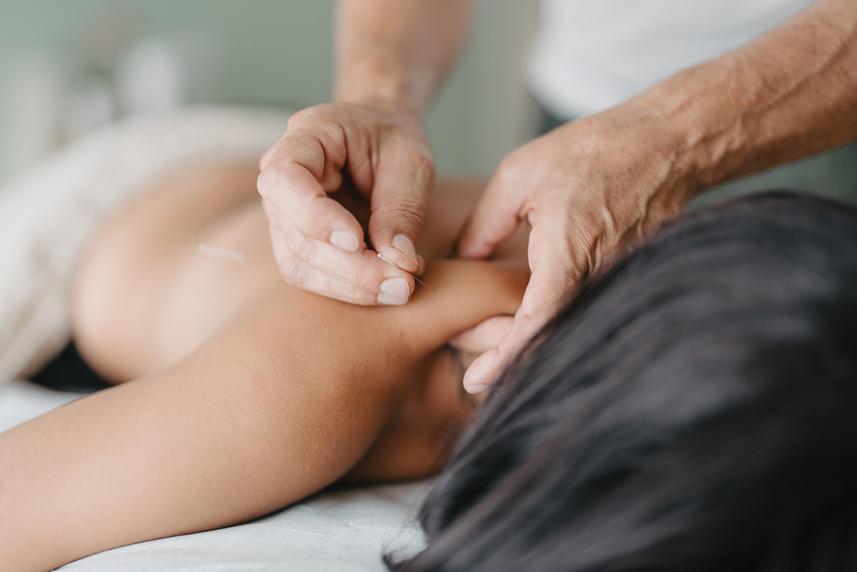 Relaxed Woman has acupuncture needles on her